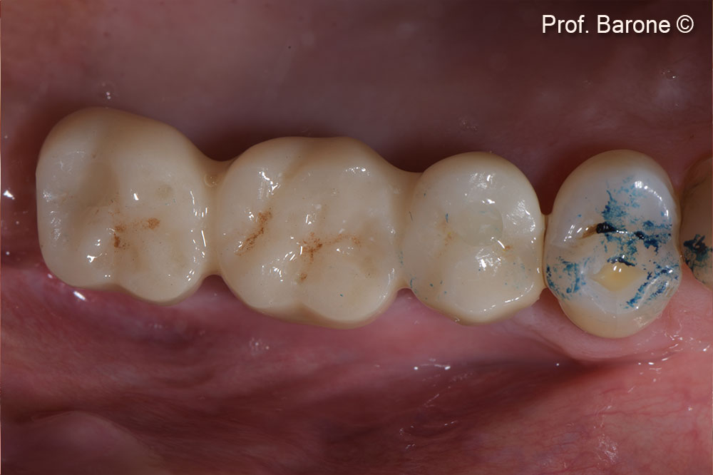 Prosthetic restoration was delivered 3 months after implant placement