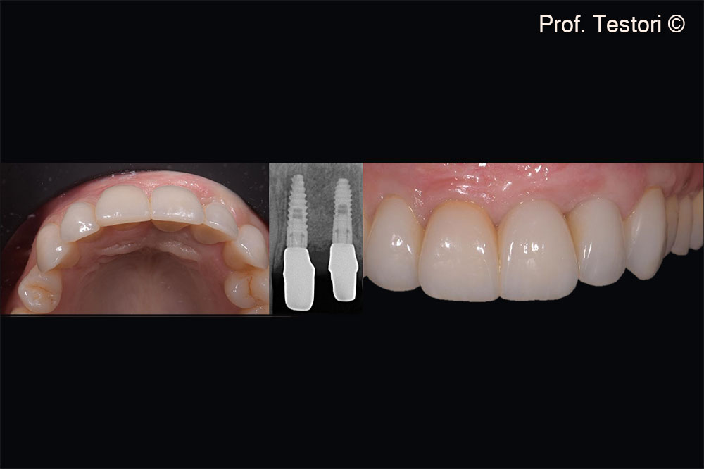 Implants are firmly anchored to newly formed bone. No signs of peri-implantitis are detected