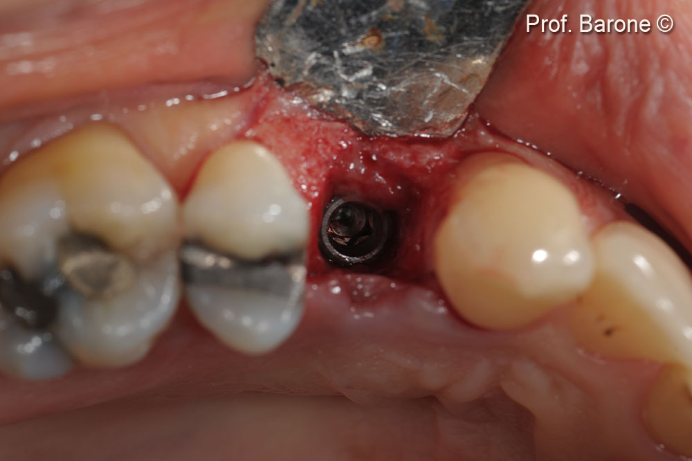 Clinical occlusal view of the inserted implant