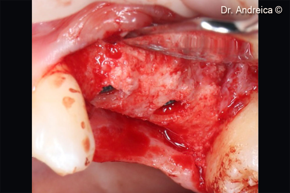 Inserting of two bone level implants with very good primary stability