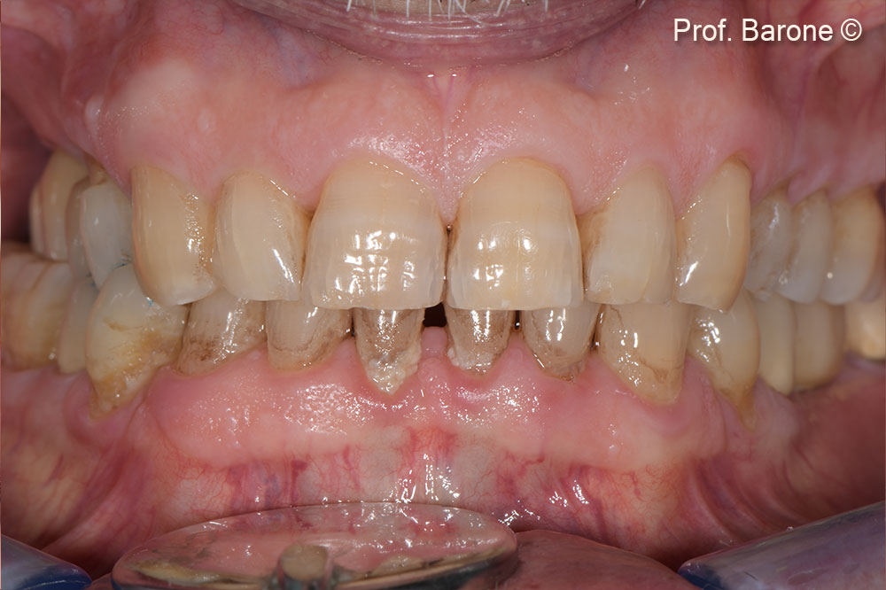 Frontal view with the restoration