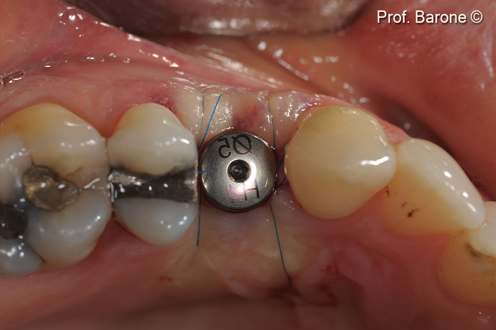Clinical occlusal view with a healing abutment