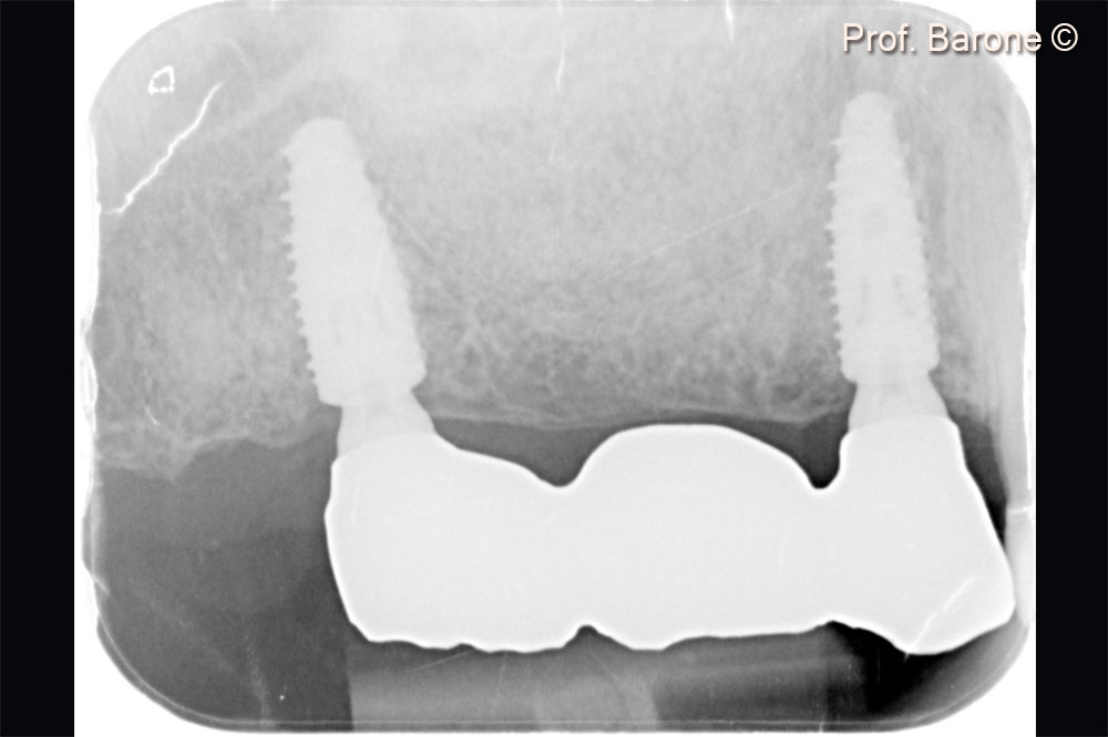 Periapical X-Ray 2 years after implant placement