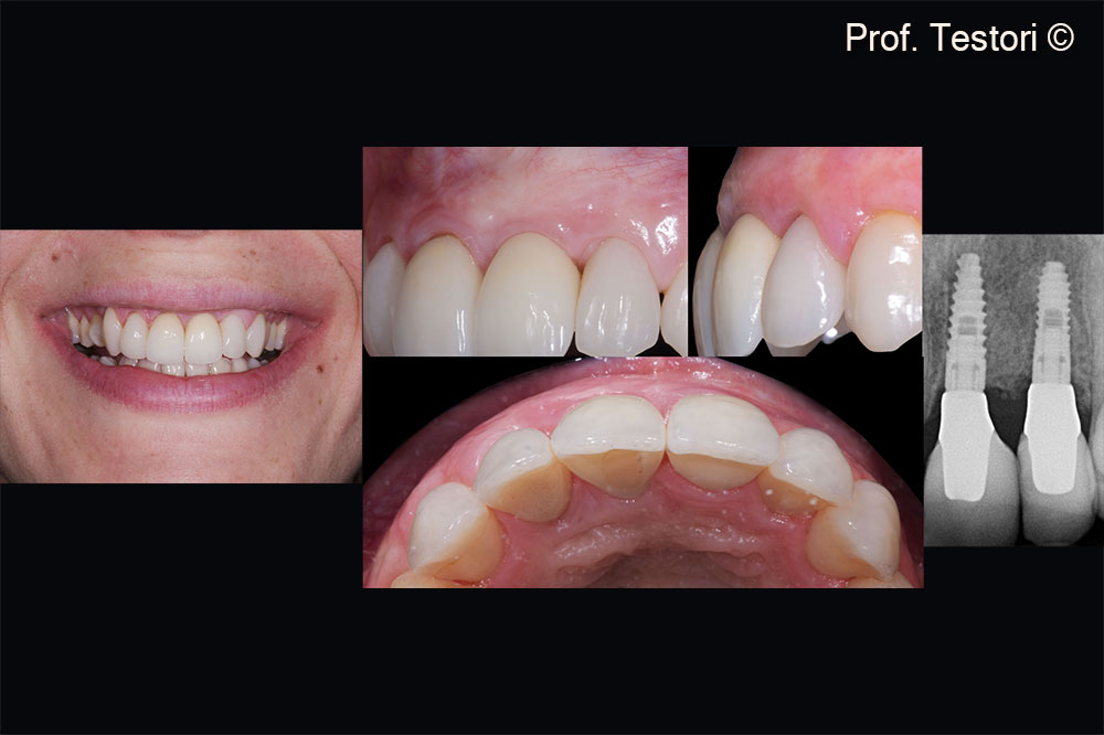 5-year follow up. Implants are firmly anchored to newly formed bone. No signs of peri-implantitis are detected.