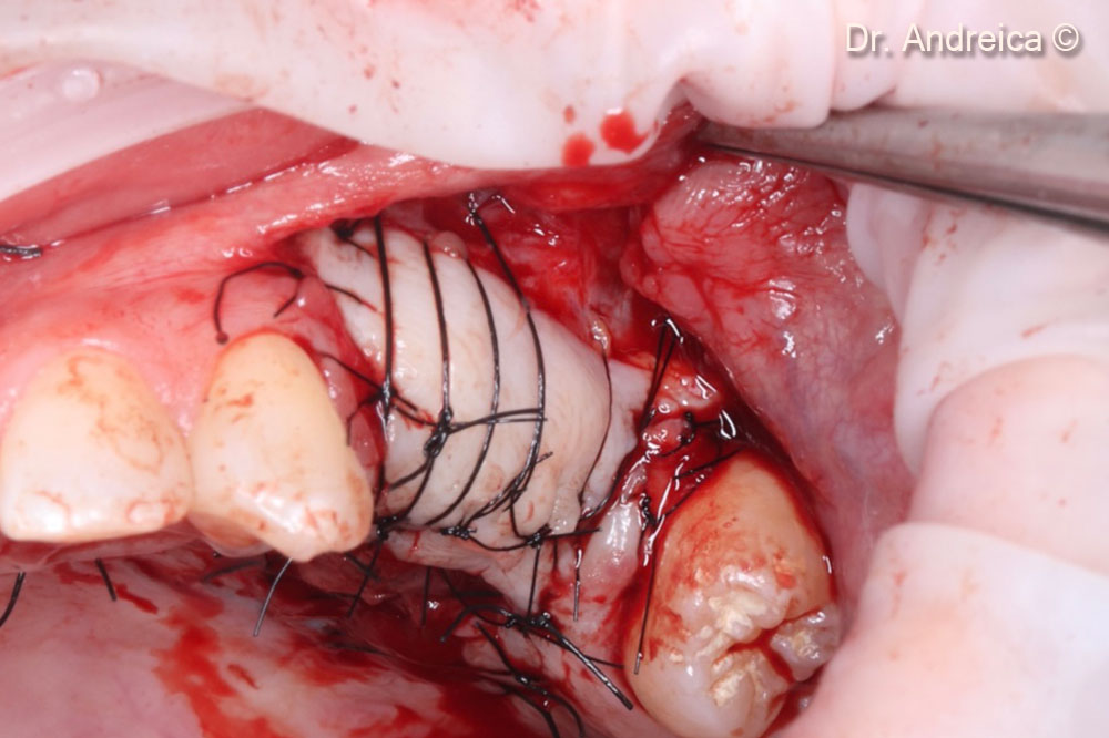 Repositioning the vestibule and increasing the keratinized tissue with a free gingival graft