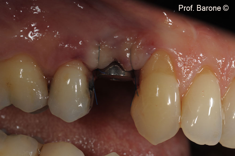 Clinical lateral view with a healing abutment