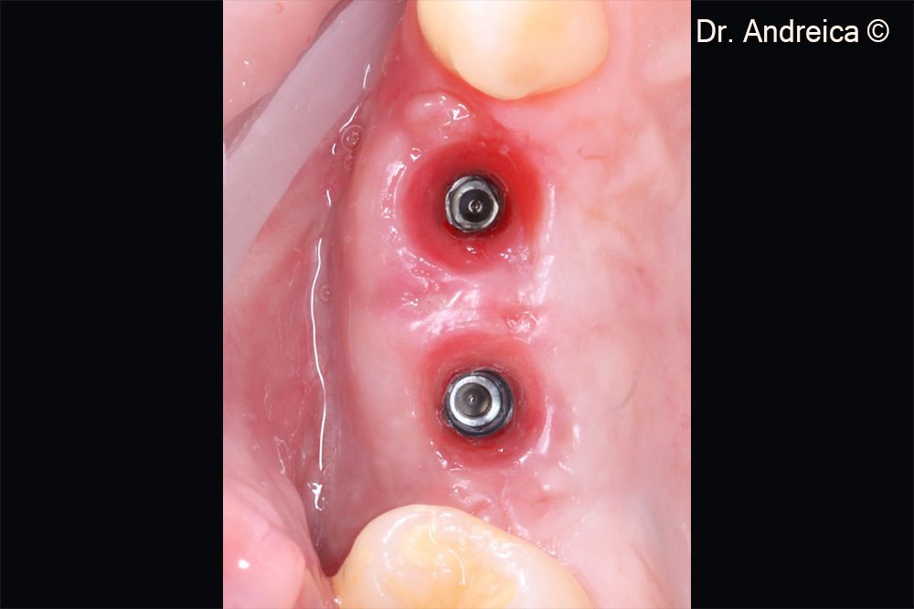 Developing of the emergence profiles after tissue healing