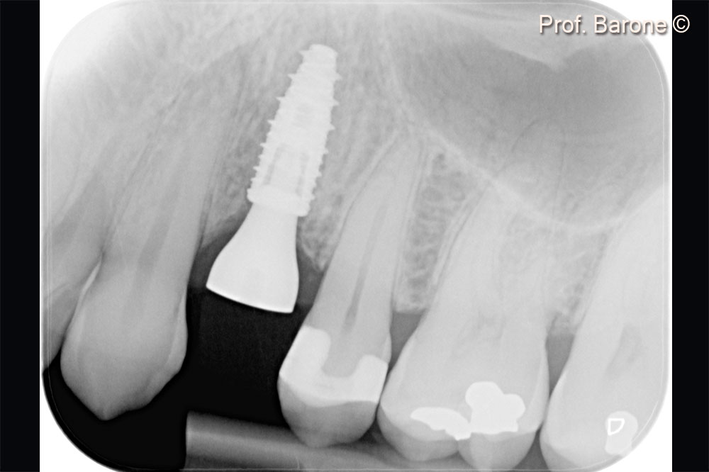 Periapical radiograph after implant placement