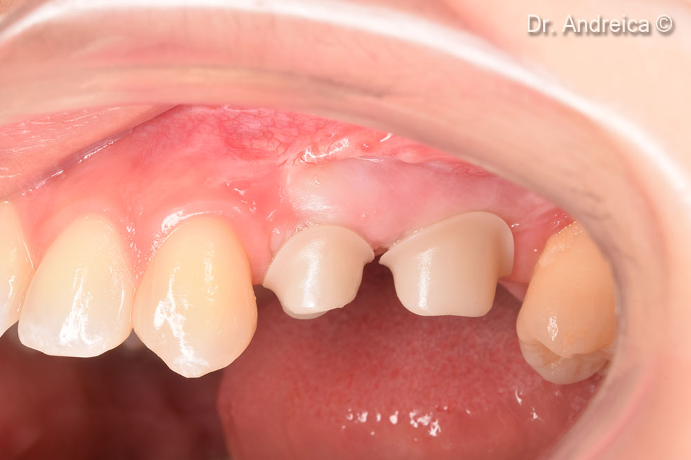 Custom Zirconia abutments and a ceramic layered Zirconia bridge cemented on top