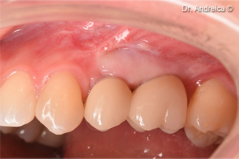 Buccal view 5 years follow up, mantaining the hard and soft tissue architecture