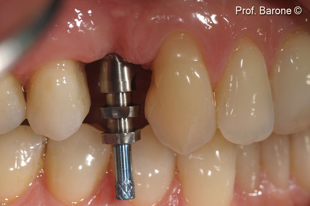 Clinical lateral view 3 months after implant placement during implant impression