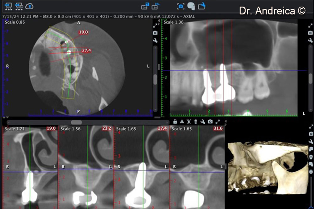 CBCT scan after 5 years showing the shrinkage of the sinus graft down to the apex of the implants and  corticalization indicating an optimal bone behaviour