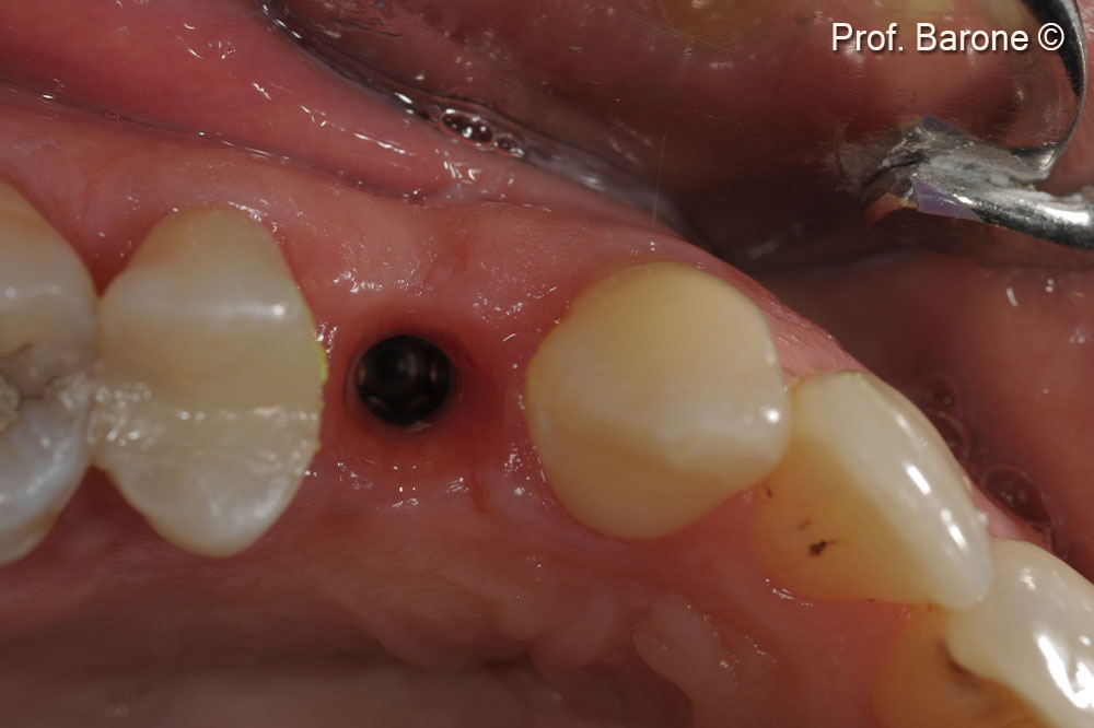 Clinical occlusal view 3 months after implant placement