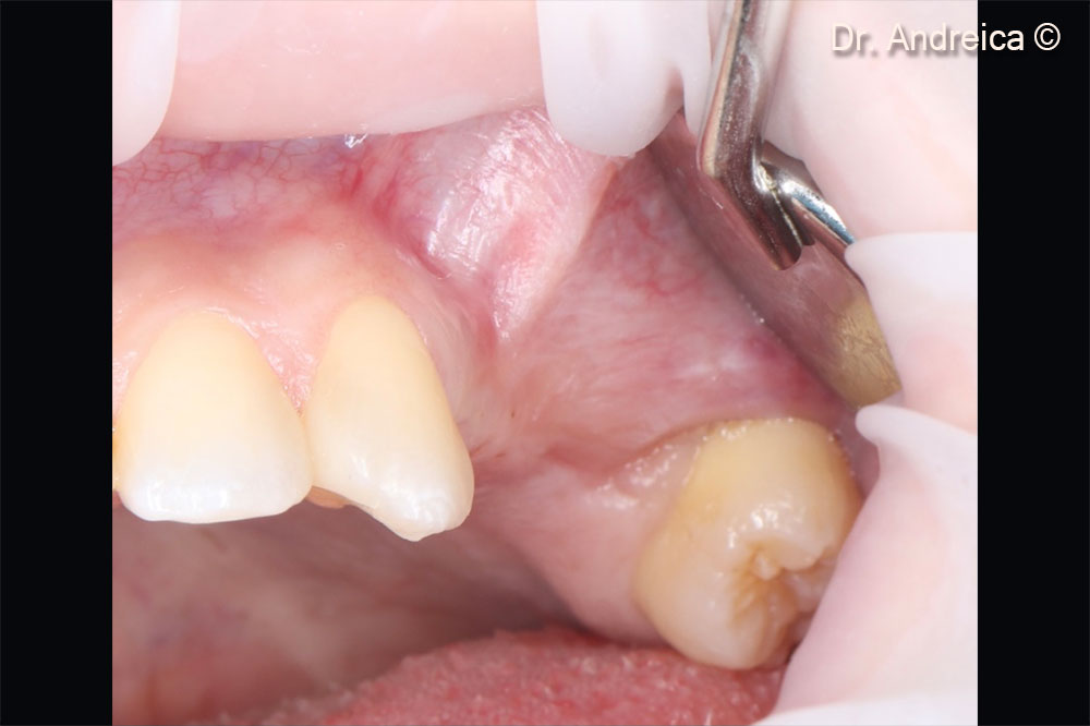 Buccal view of the posterior left maxilla showing a lack of the vestibule and a mucogingival line displaced palatally