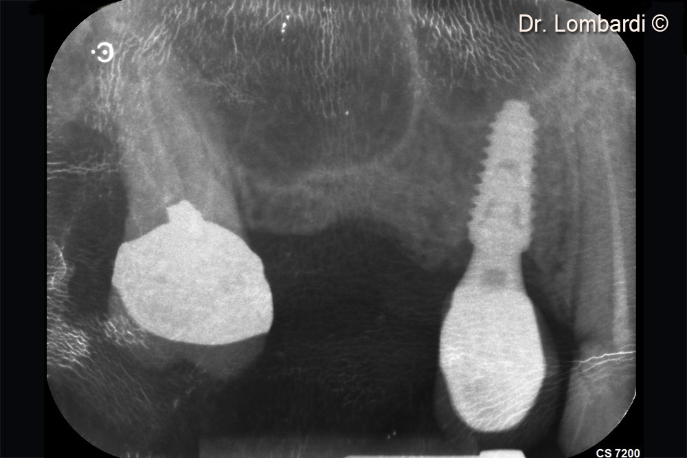 The bone crest needs to be augmented before implant placement