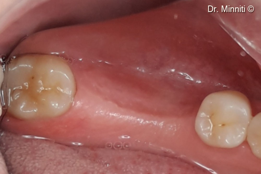 Initial situation. The photo shows a severe atrophy in position 4