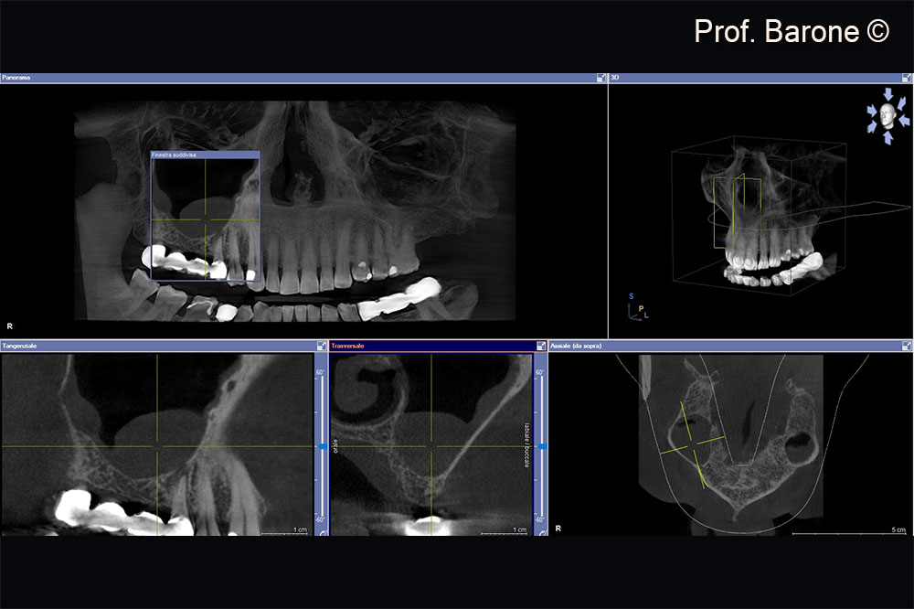 Residual ridge height doesn’t allow implant placement