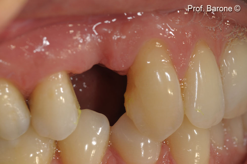 Clinical lateral view 3 months after implant placement