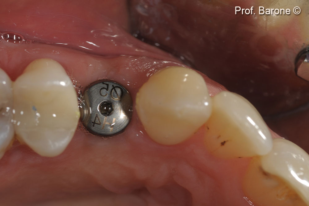 Clinical occlusal view 3 months after implant placement