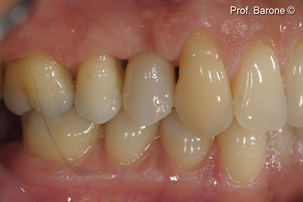 Clinical lateral view at final crown delivery