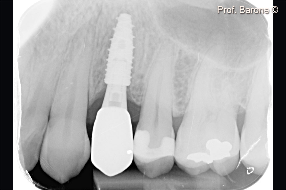 Periapical radiograph after crown delivery