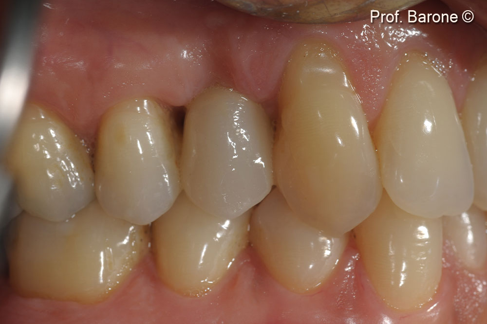 Clinical lateral view 3 weeks after final crown delivery