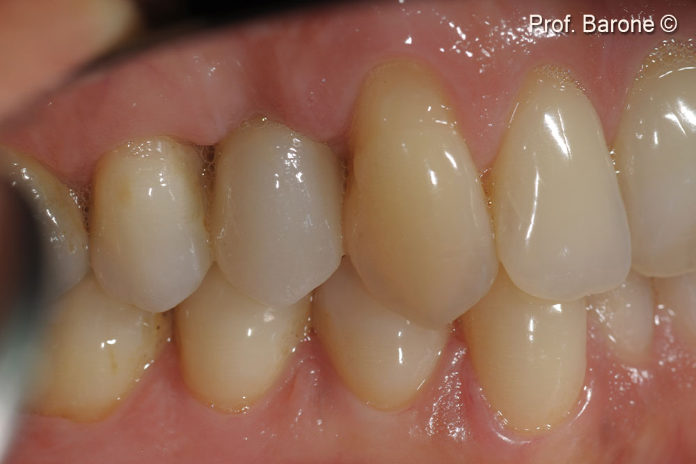 Clinical lateral view 6 weeks after final crown delivery