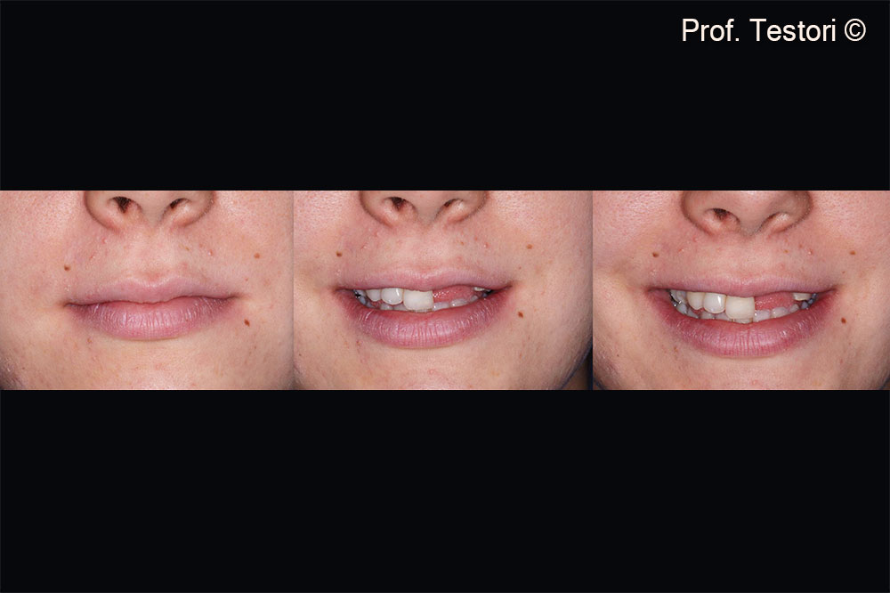 The patient shows a severe defect in the esthetic area