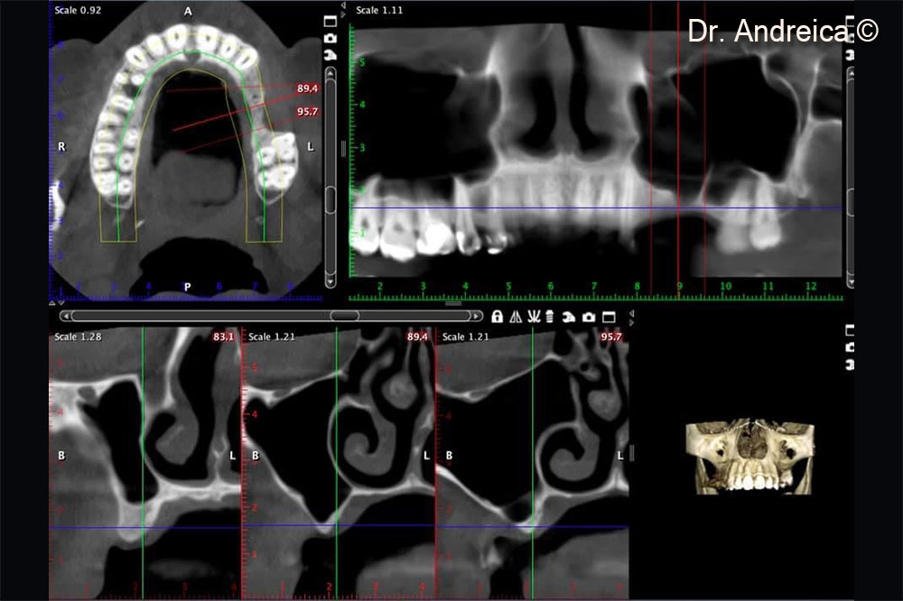 CBCT scan shows a very thin crest vertically and horizontally especially in the molar region and  the presence of a transversal septa. The osteo-meatal complex is patent