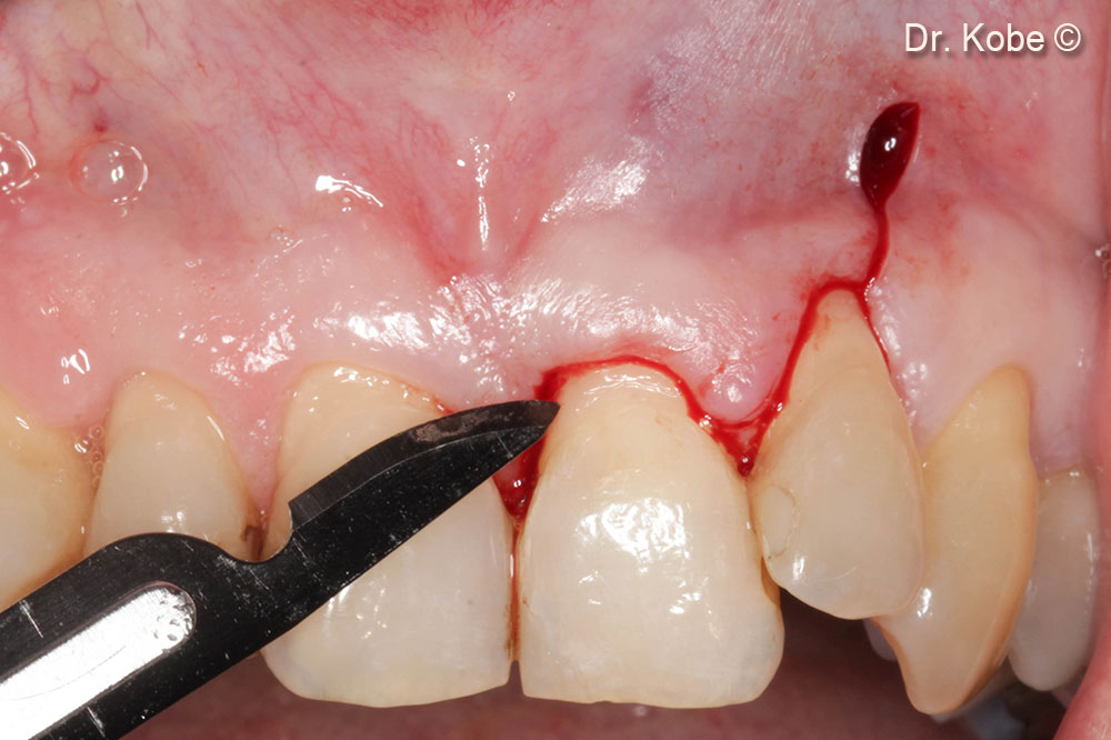 Vertical incision at the adjacent tooth, preserving the papillae