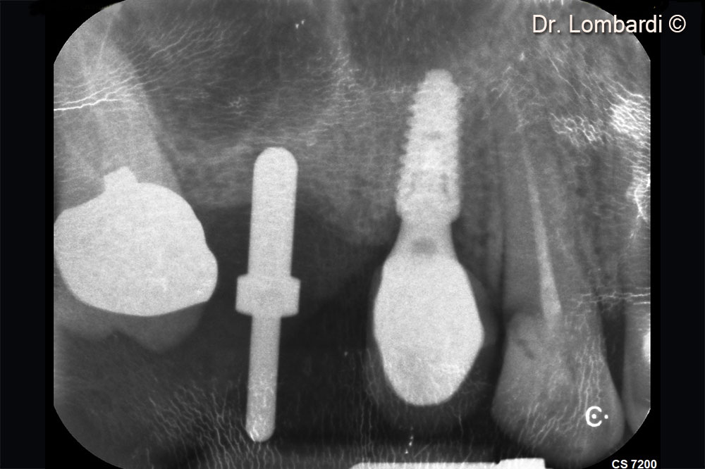 The bone crest needs to be augmented before implant placement