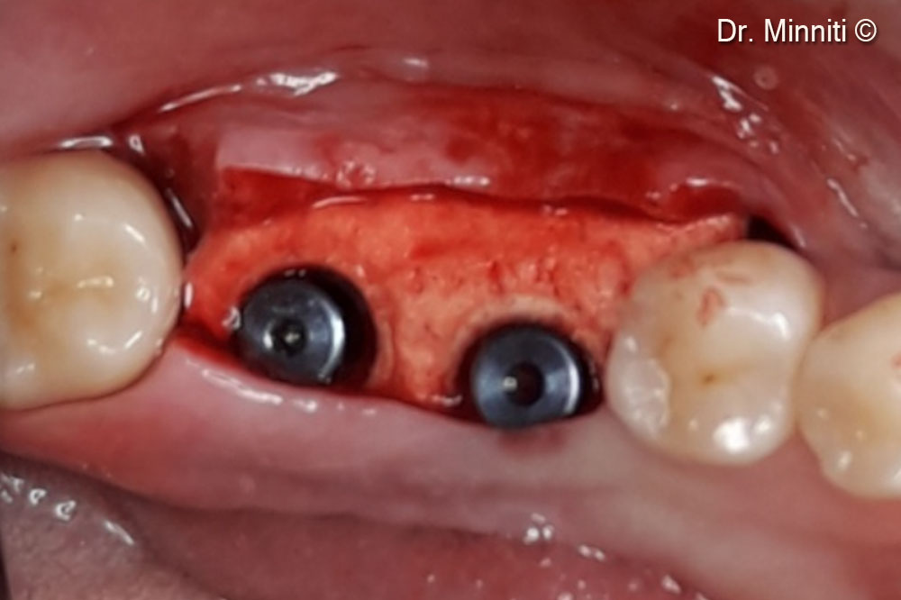 Derma 2 mm used to augment the soft tissues