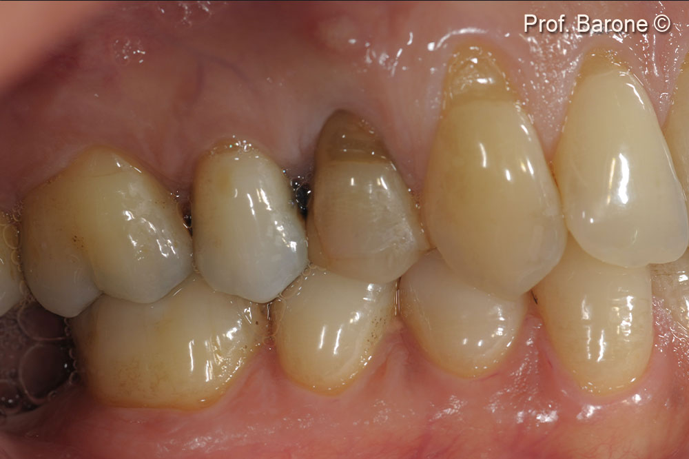 Clinical pre-operative lateral view of the tooth #24 (gingival recession and a fistula can be observed)