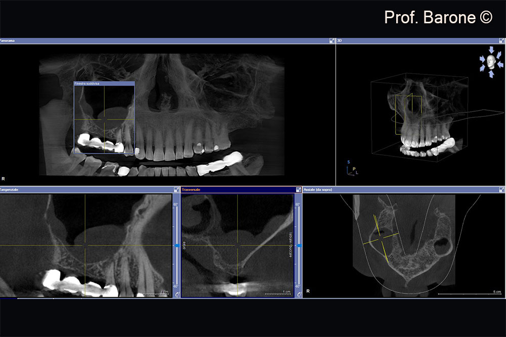 Residual ridge height doesn’t allow implant placement, sinus membrane hypertrophy