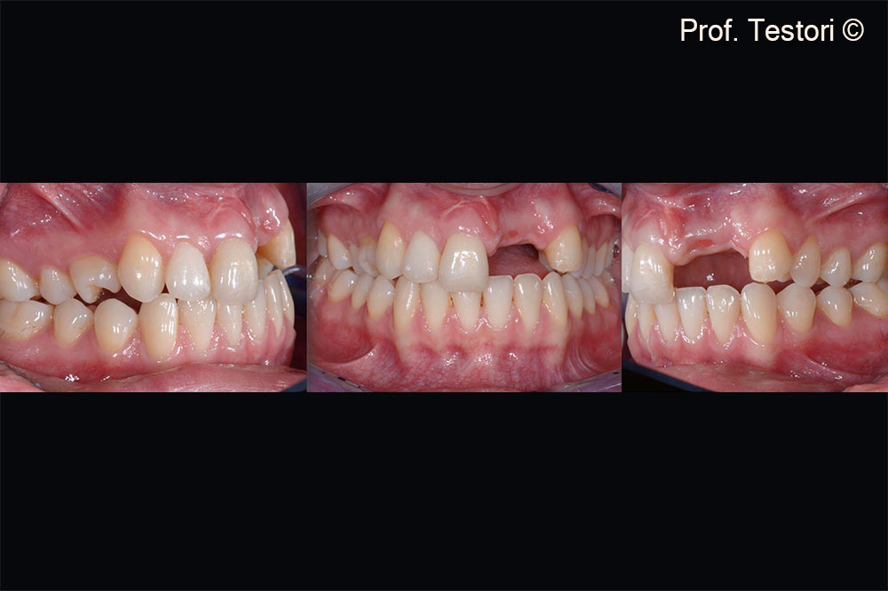 The patient shows a severe defect in the esthetic area