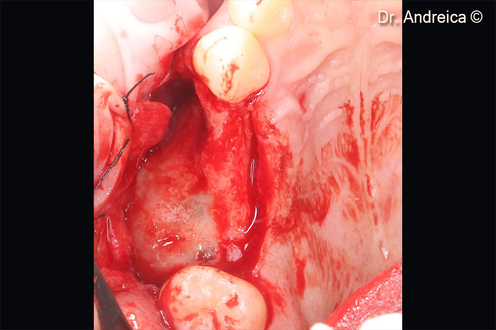 Occlusal view after raising full thickness flaps showing the very thin residual crest