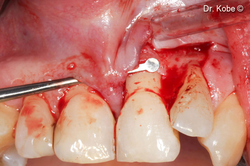 Tunneling of the papillae