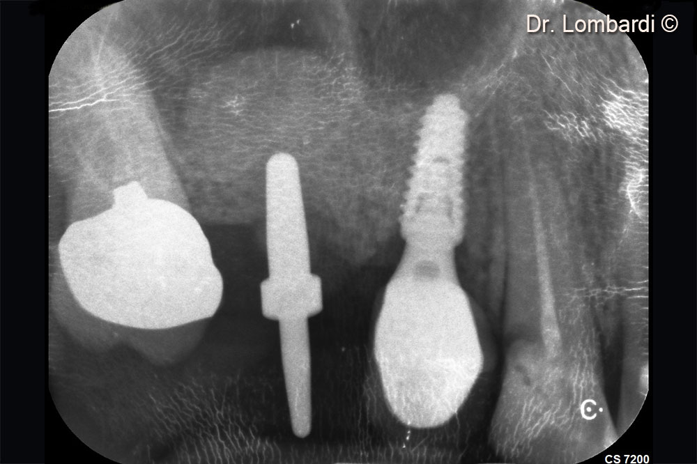 Putty gently detaches and displaces the sinus membrane
