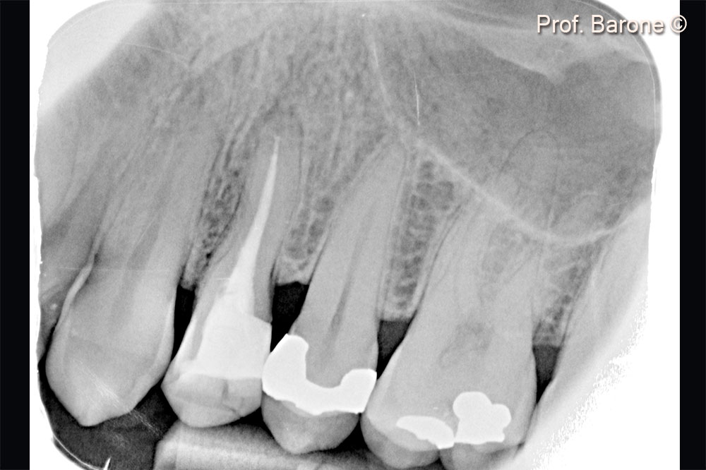 Pre-operative periapical radiograph