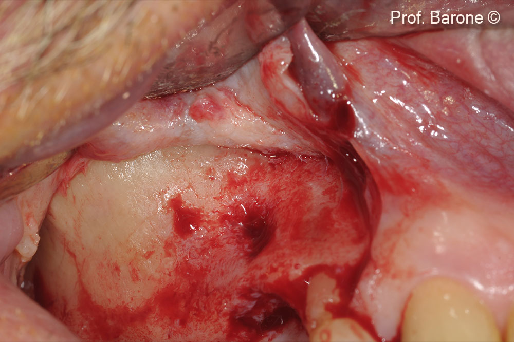 Surgical access to the antero-lateral bone wall