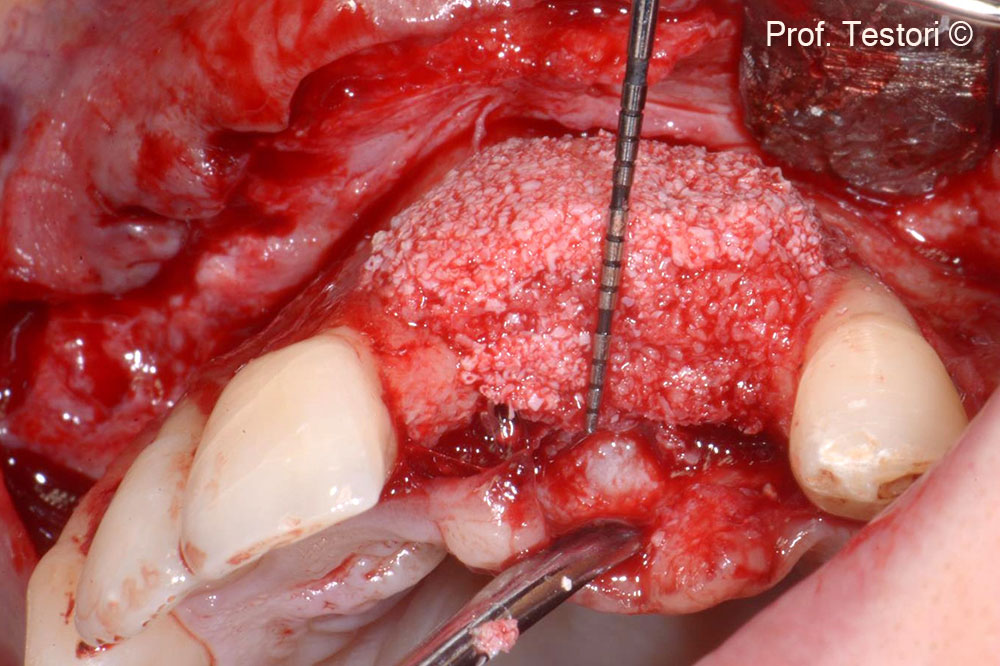 A sticky bone is used to reconstruct the bone horizontally