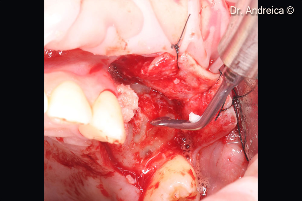 Scraping the bone with a sharp piezoelectric insert for collecting bone chips when preparing  the lateral window acces