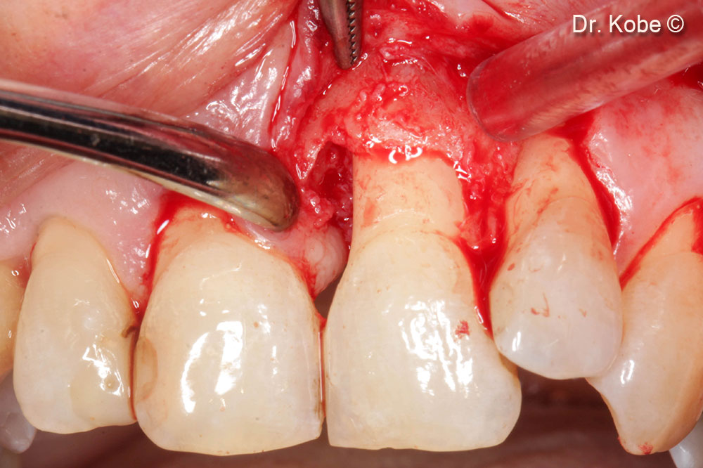 Access and cleaning of the defect
