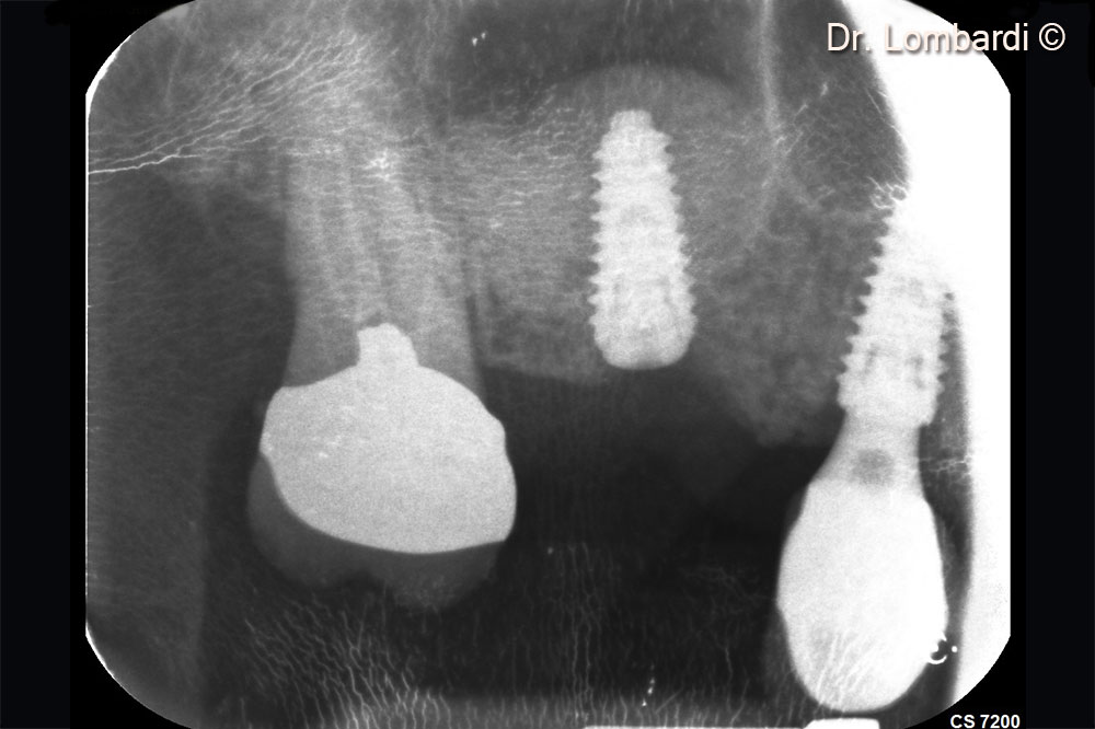 Immediate implant insertion is required to counteract the physiological biomaterial shrinkage