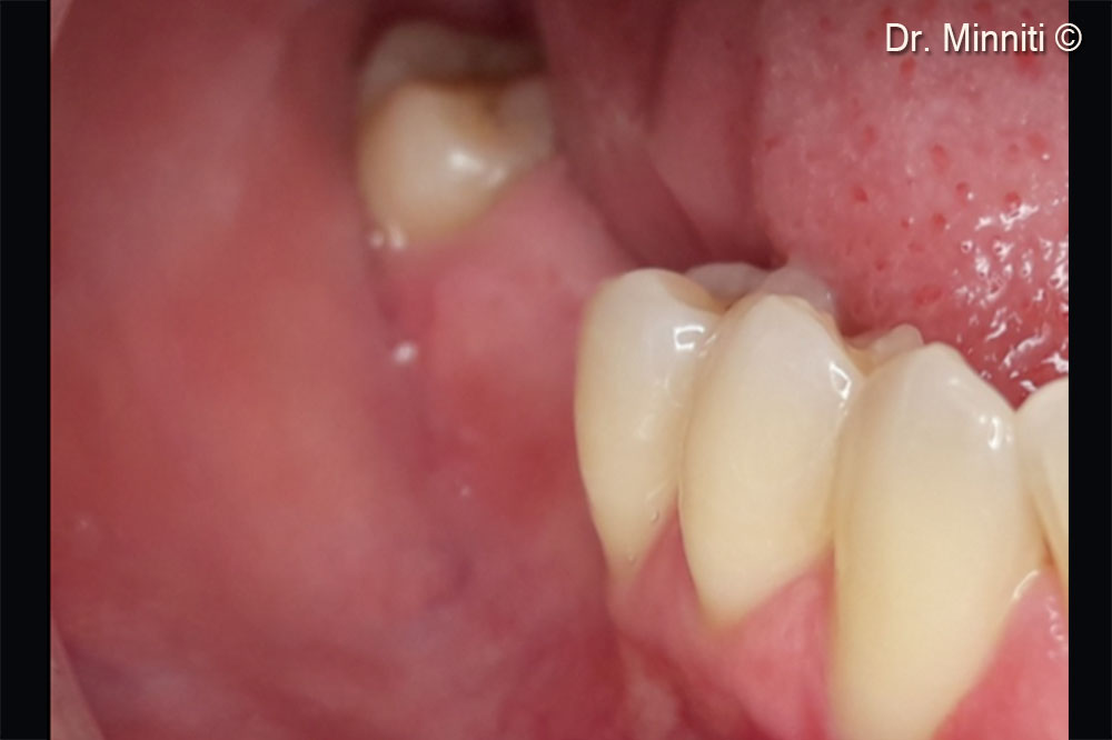 Initial situation. The photo shows a severe atrophy in position 4 - lateral view