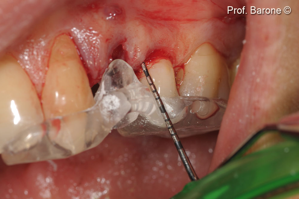 Tooth extraction and use of a surgical guide to measure vertical bone changes throughout the time