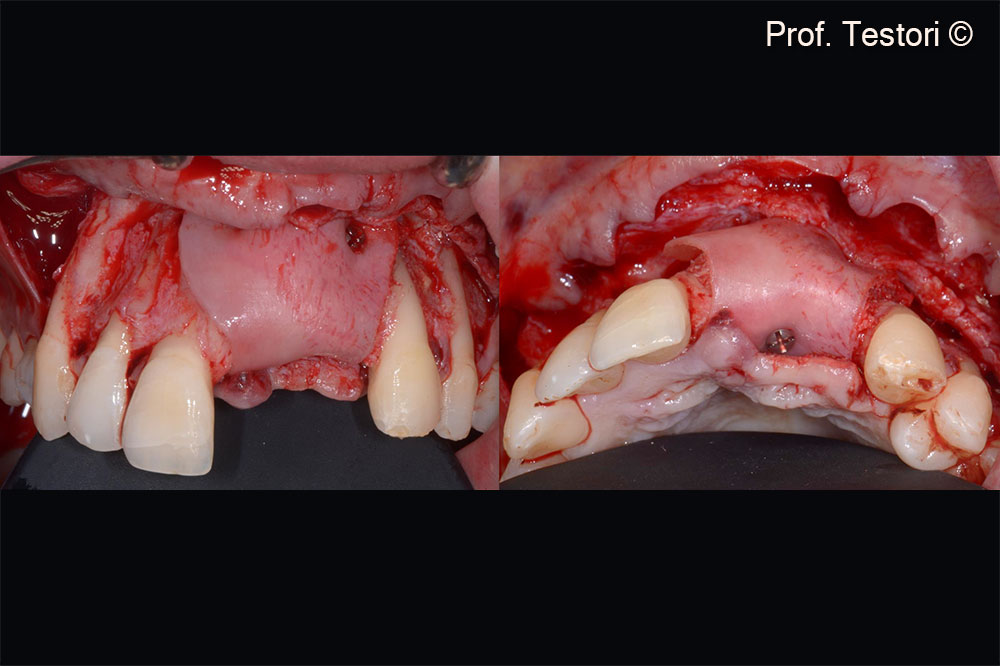 Lamina® is used to reconstruct the missing buccal bone. Lamina® has been fixed to avoid micromovents that may jeopardise new bone formation.