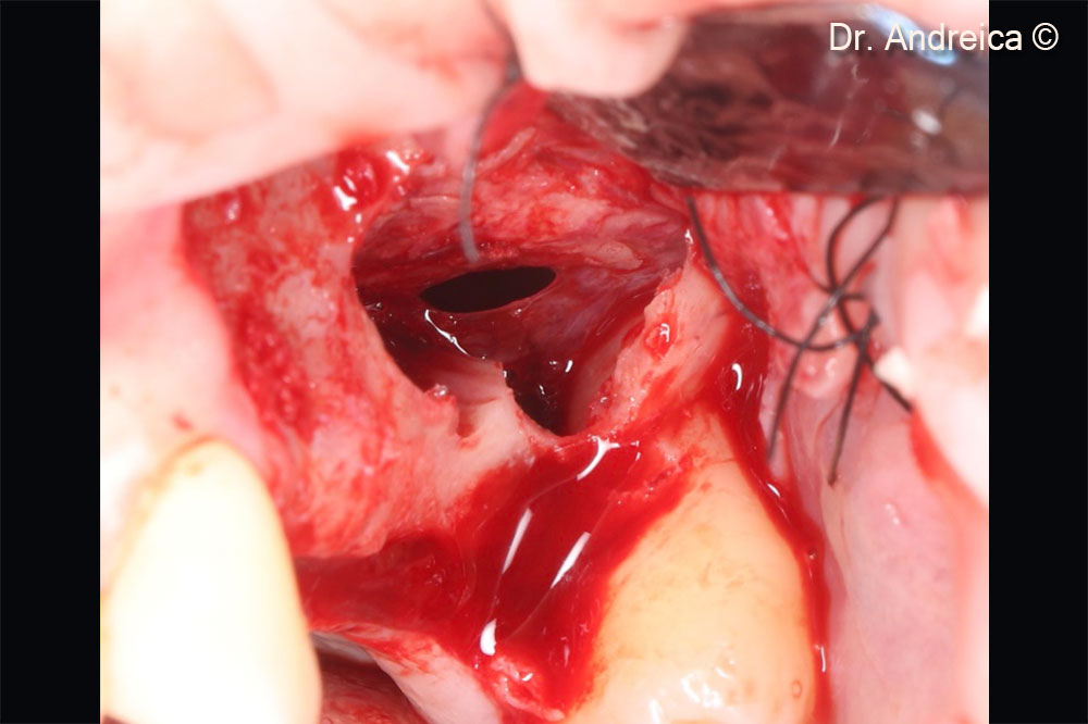 During membrane elevation a perforation occurred at the tip of the septa