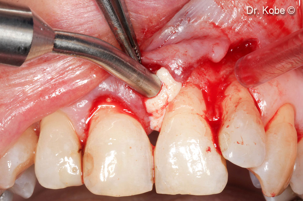 Defect filled with Gel 40