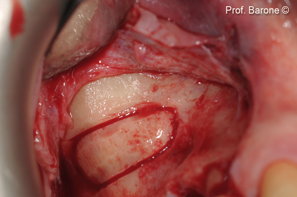 Osteotomy window performed with surgical ultrasounds